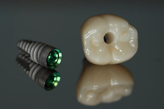 Implants Great Oak Dental Care